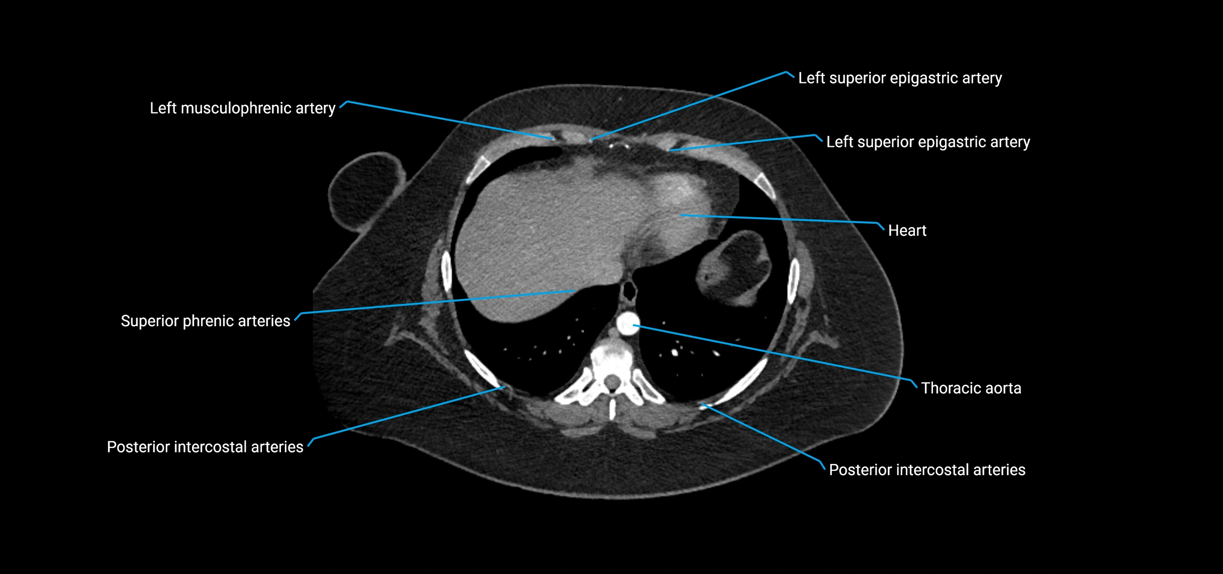 CTA abdomen axial cross sectional anatomy labelled image_15 (2).webp